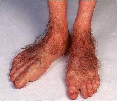 Pictures ugly feet 