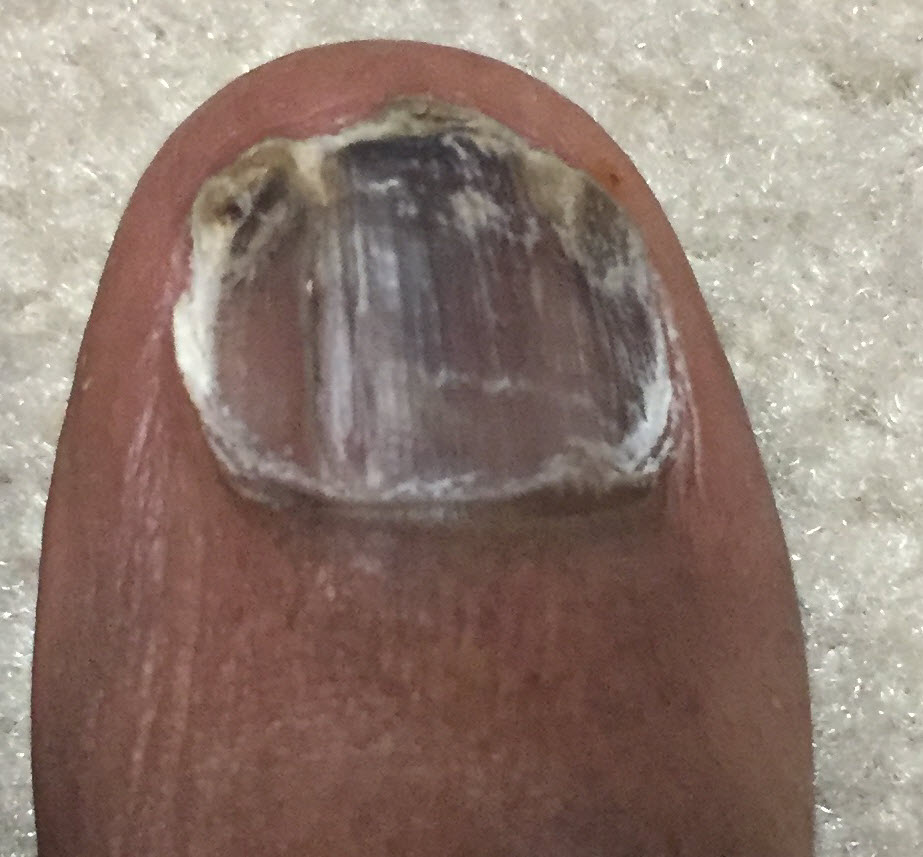 toe after 8 months of jublia
