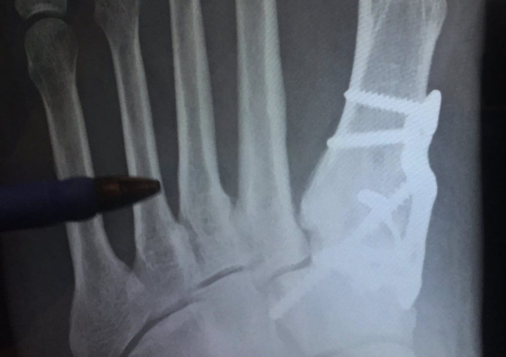xray after bunion surgery