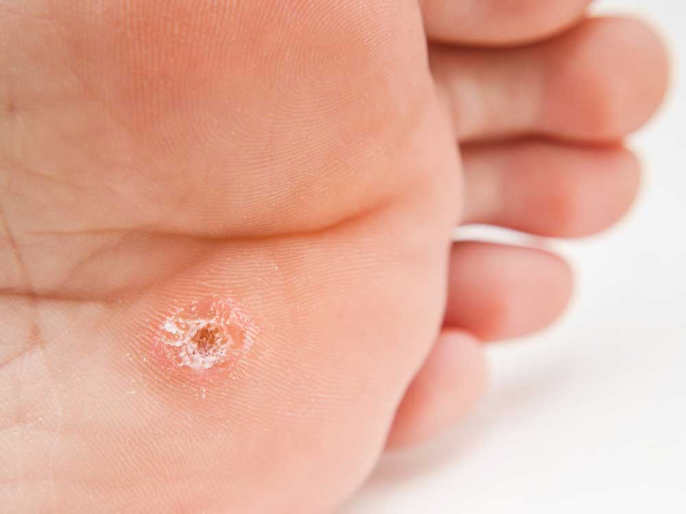 How to Get Rid of Plantar Warts Goody Foot