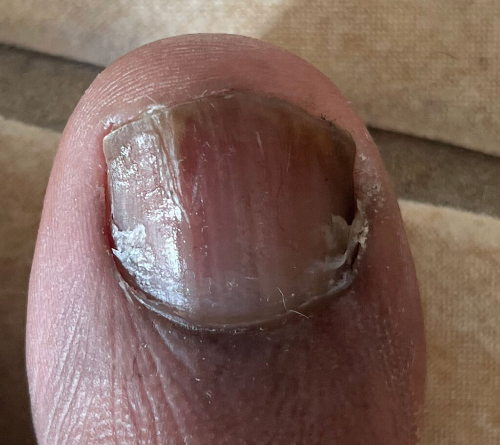 healthy-toe-nail-no-fungus