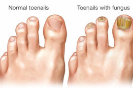 toenail-fungus