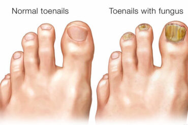 toenail-fungus