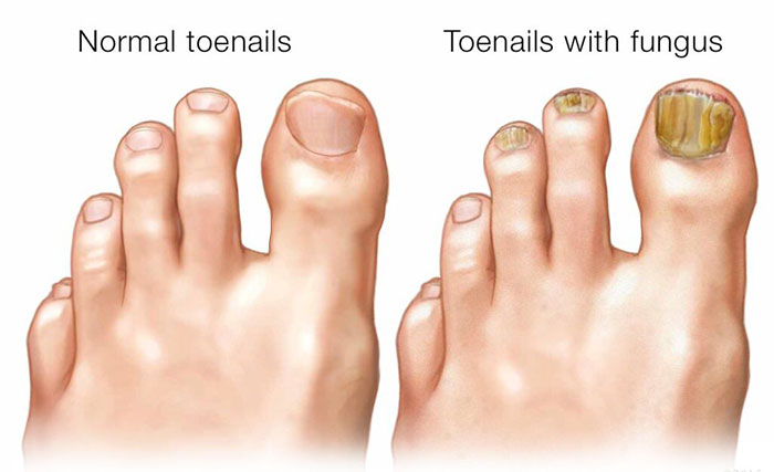 toenail-fungus